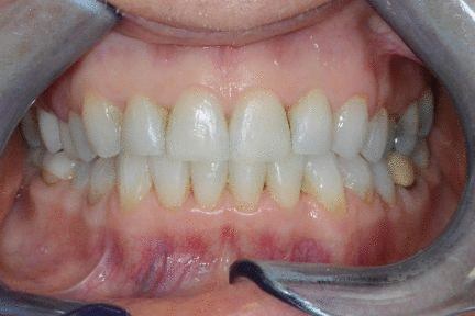 aligning-beauty-teeth