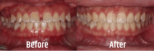 aligning-beauty-before-after