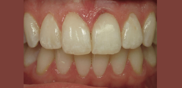 teeth-fillings